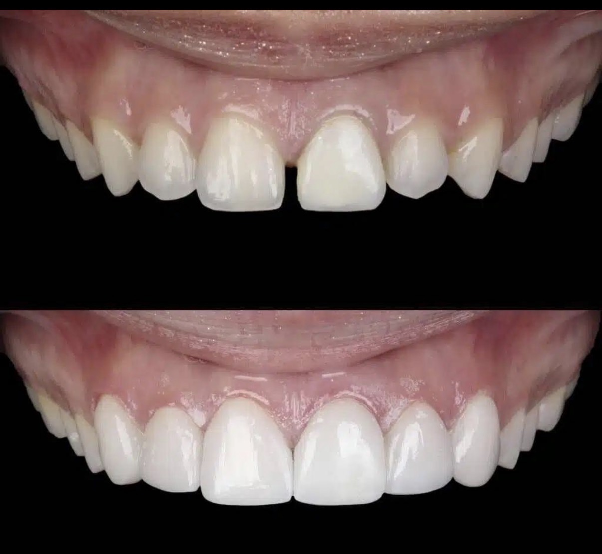 Prótese e Implante Dentário