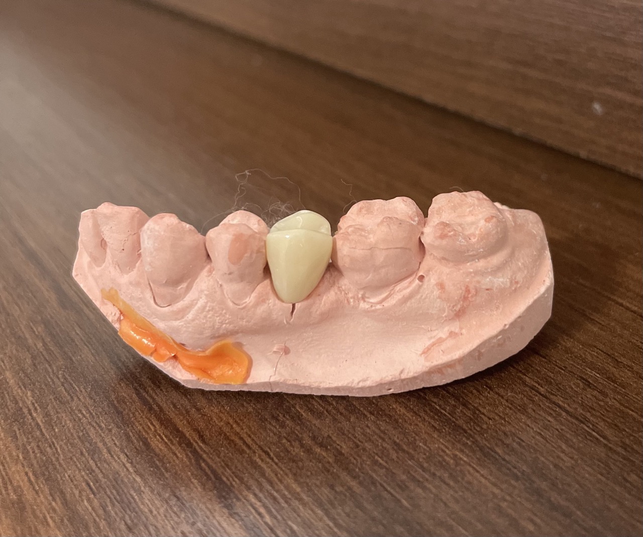 Prótese e Implante Dentário